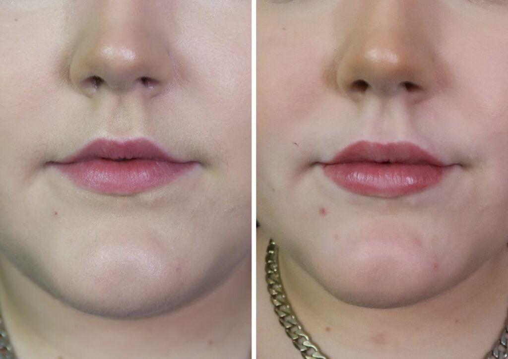 Teosyal lip augmentation fillers before and after