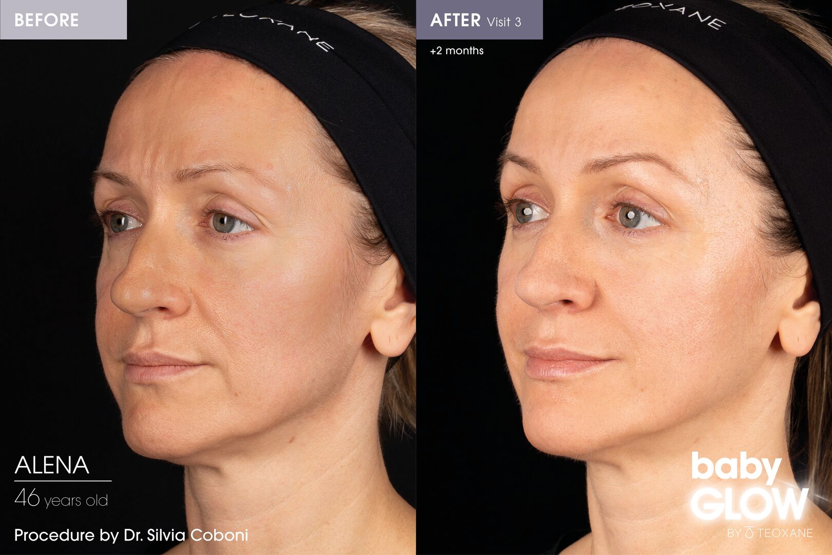 Teoxane Baby Glow - Skin glow treatment before and after result 2 months+ post treatment
