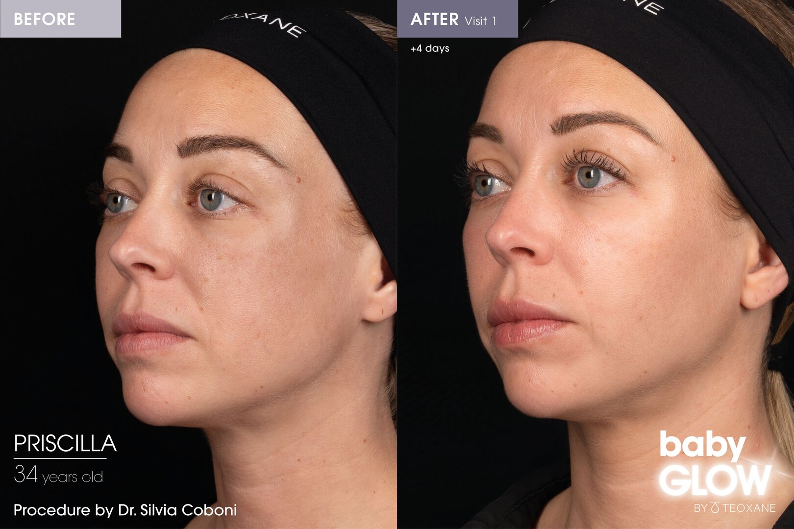 Teoxane Baby Glow - Skin glow treatment before and after result 4 days+ post treatment
