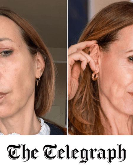 The Cosmetic Skin Clinic Featured in The Telegraph for BBL Skin Rejuvenation
