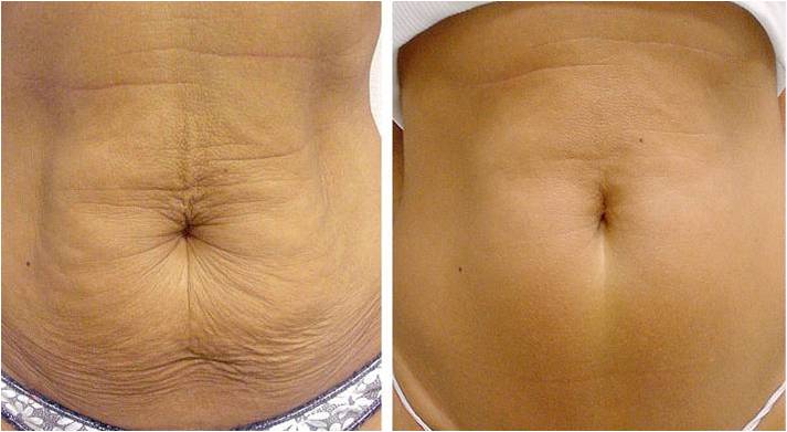 Thermage CPT abdomen before and after