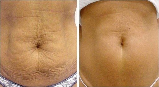 Winrkly skin on abdomen - Thermage abdomen before and after