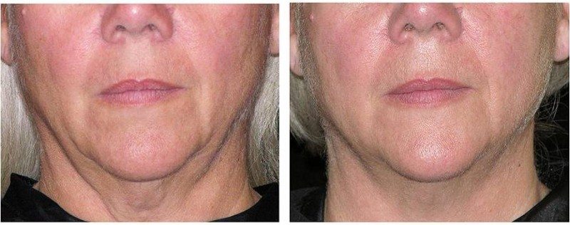Thermage CPT before and after lower face