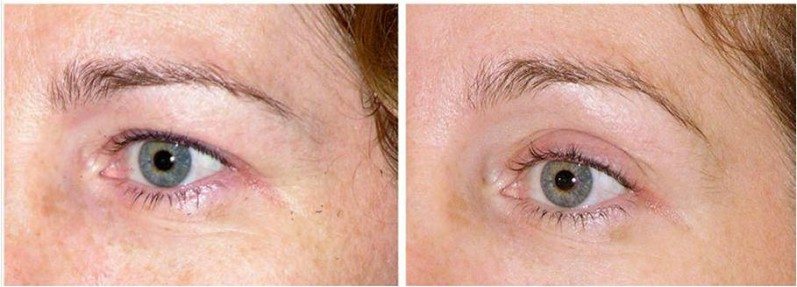 Thermage CPT eyes before and after