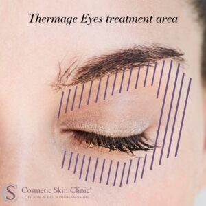 Thermage Eyes treatment area