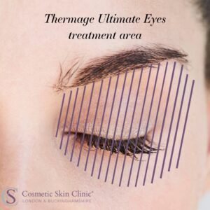Thermage Ultimate Eyes treatment area