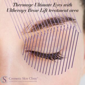 Thermage Ultimate Eyes with Ultherapy brow lift treatment area