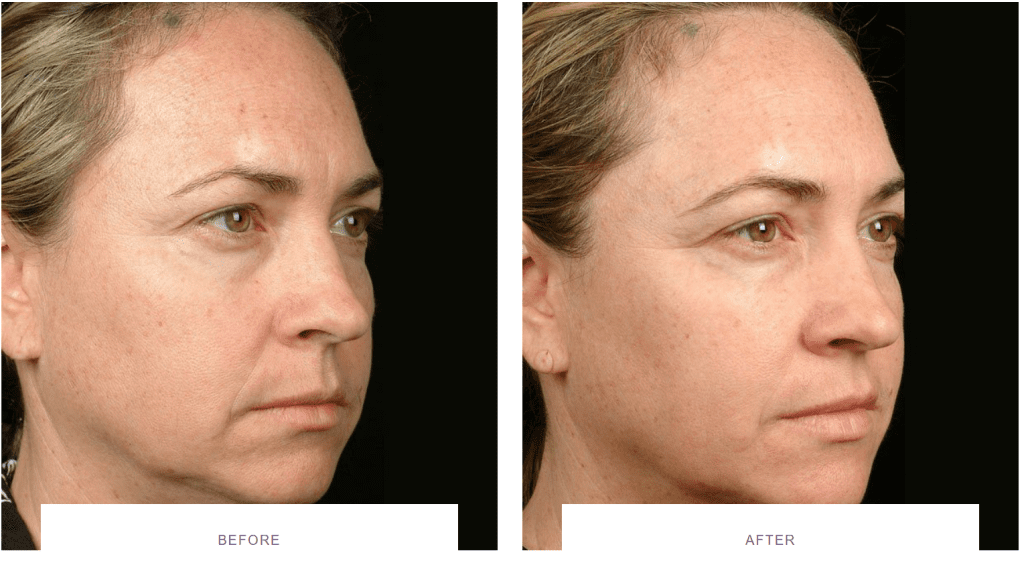 thermage skin tightening before and after