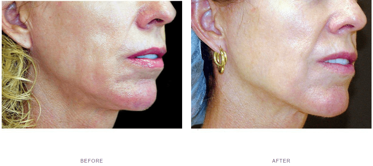 Laser Skin Tightening before and after Thermage, Morpheus8, Ultherapy