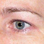 Thermage eyes before
