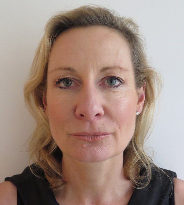 Thread Lift Non-surgical Facelift After