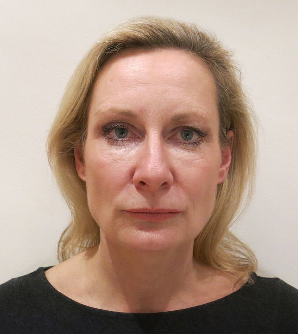 Thread Lift Non-surgical Facelift Before