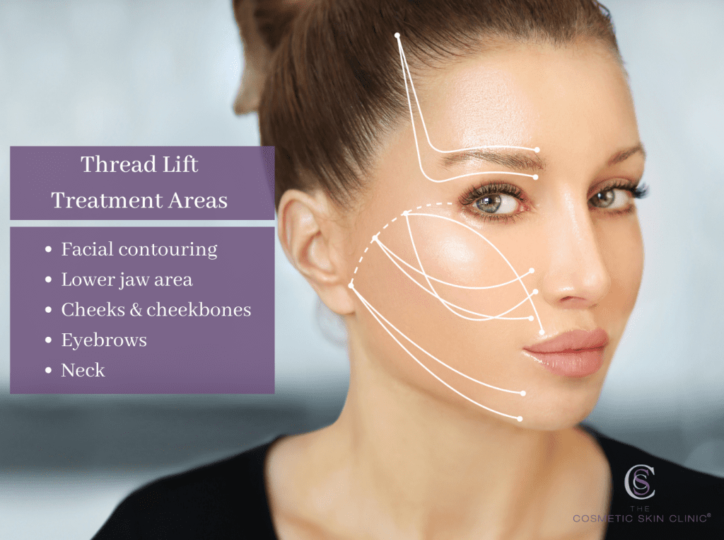 thread lift treatment areas