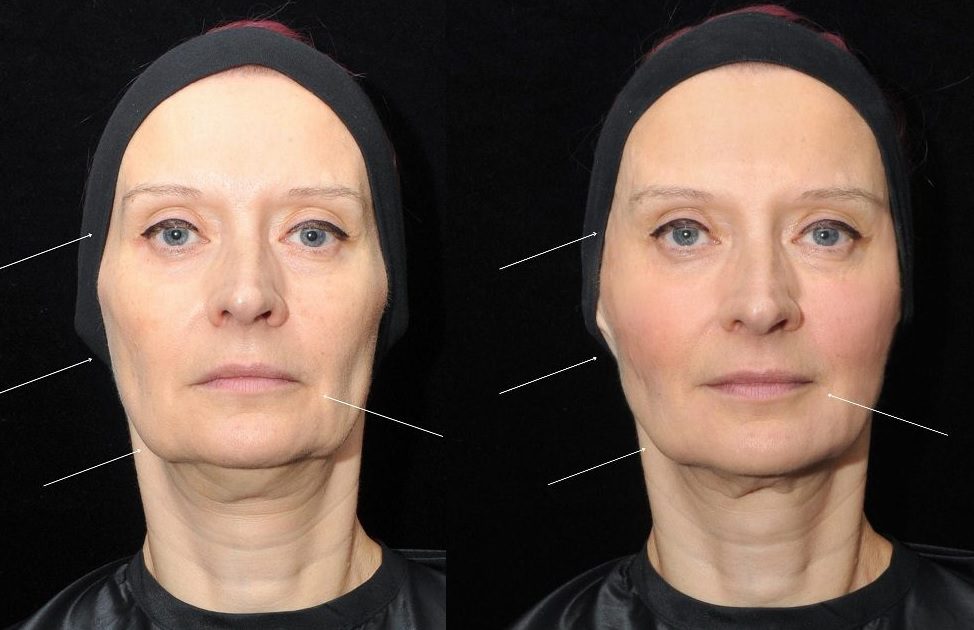 Replace Lost Volume in The Face With Fillers The Cosmetic Skin Clinic