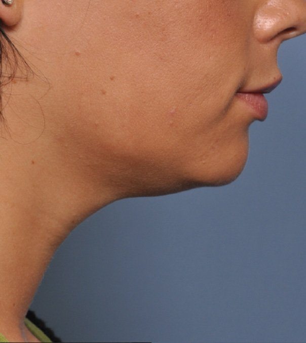 After Ultherapy treatment to jawline and neck