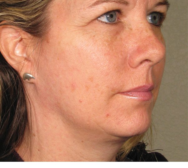 A lady before having Ultherapy treatment