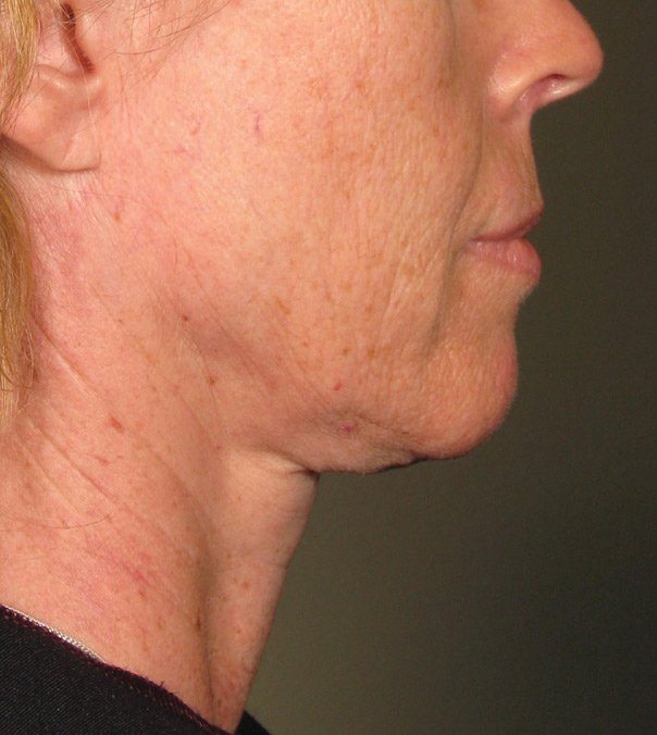 Before Ultherapy treatment to neck