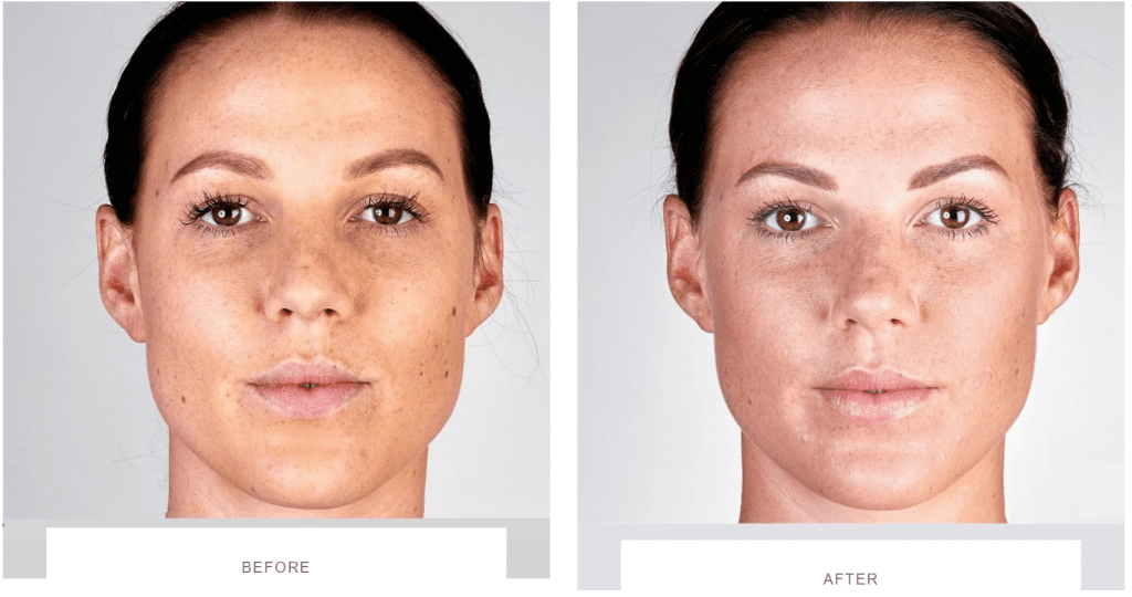 ultherapy jawline before and after