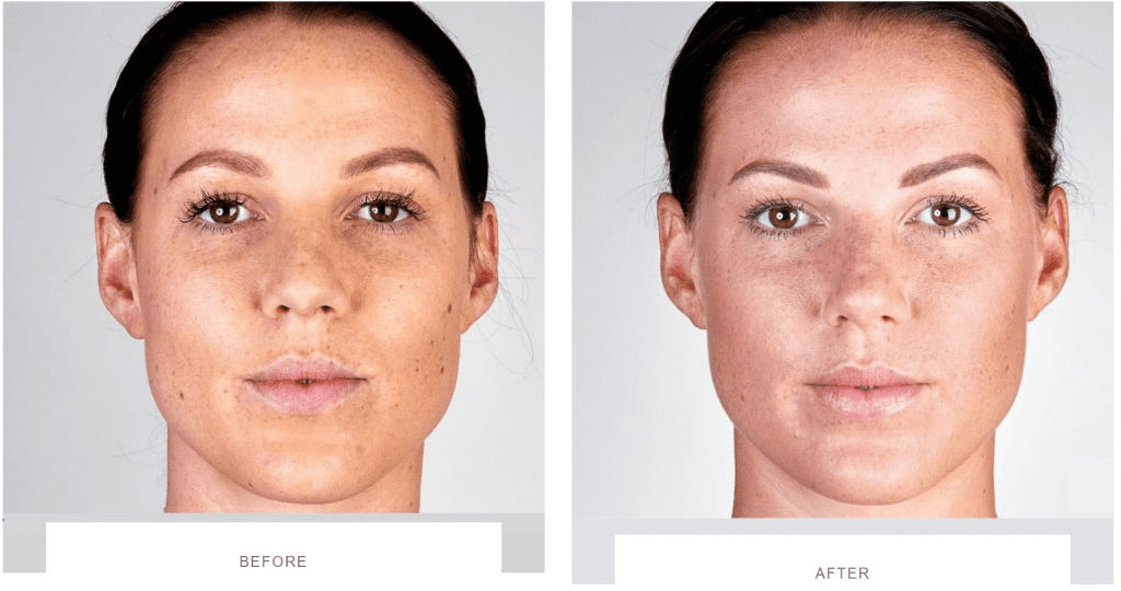 SKIN TIGHTENING BEFORE & AFTER PHOTOS