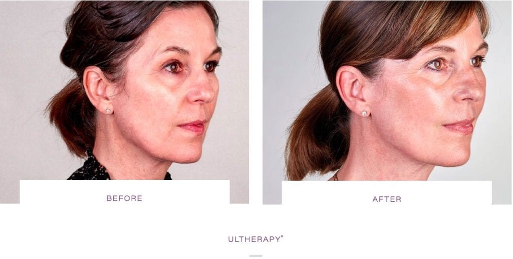sagging jowls before and after, how to get rid of jowls, non surgical jowls treatment