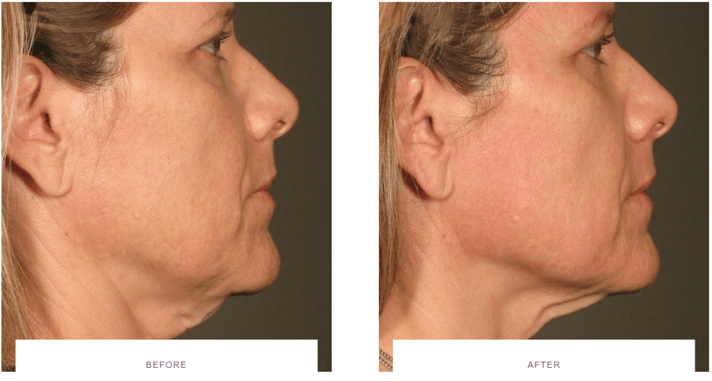 ultherapy neck lift before and after