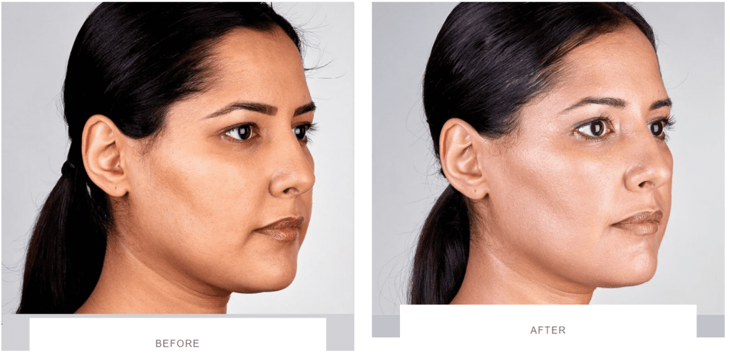 ultherapy full face before and after