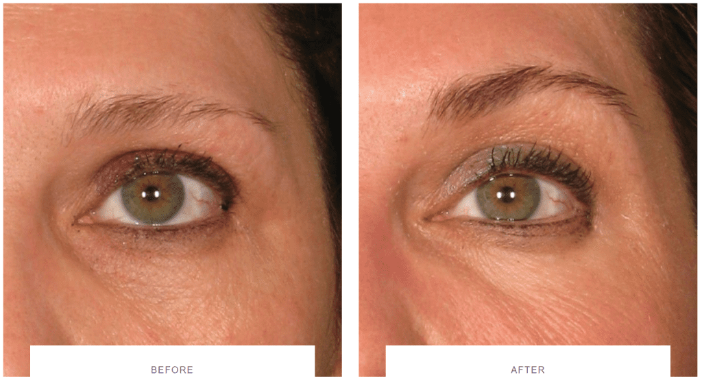 ultherapy eyes before and after