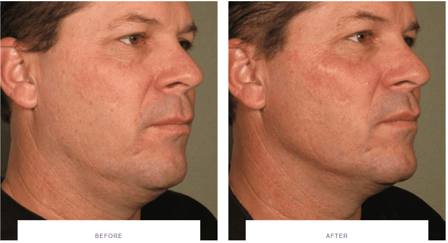 Laser Skin Tightening before and after Thermage, Morpheus8, Ultherapy