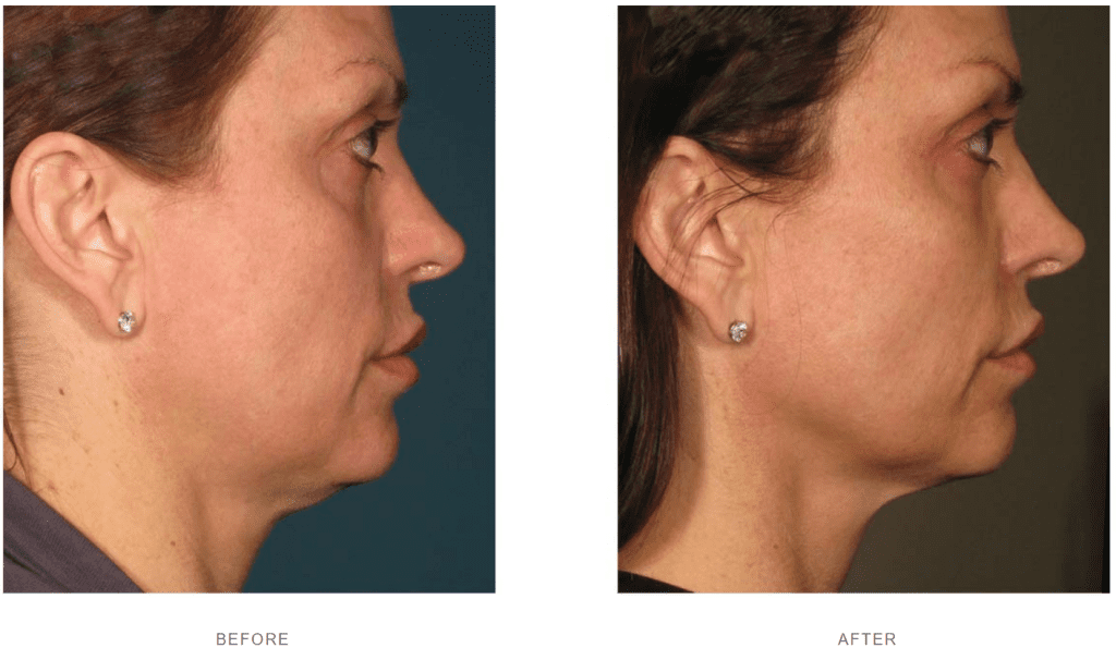 ultherapy neck lift before and after