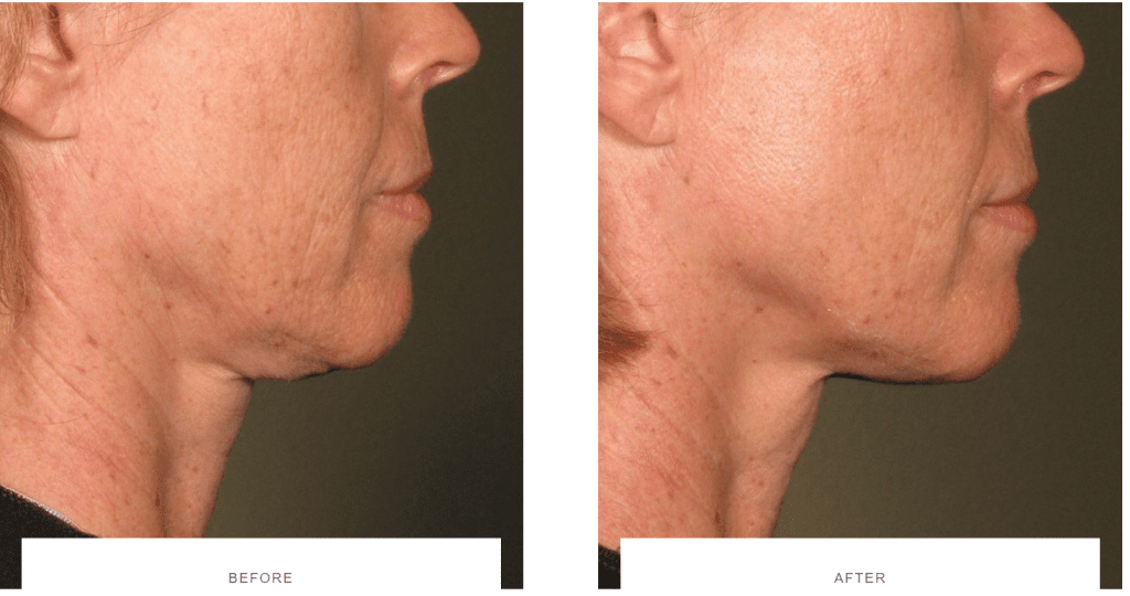 ultherapy jawline before and after