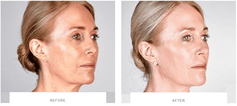 ultherapy full face before after