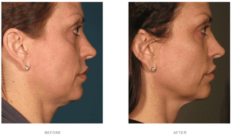 ultherapy turkey neck before after