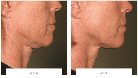 ultherapy neck lift before after