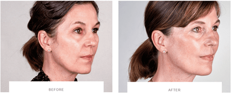 ultherapy skin tightening before after