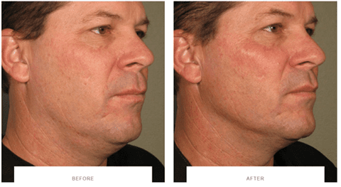 ultherapy jawline before after