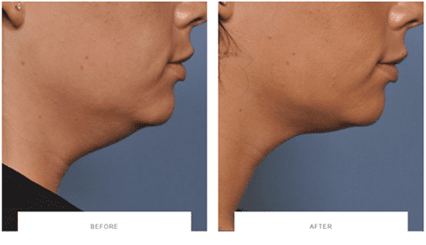 ultherapy turkey neck before after