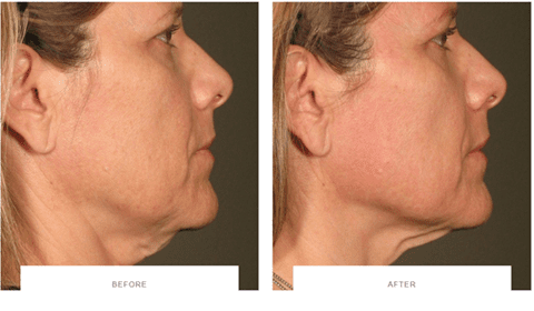get rid of turkey neck with ultherapy before after