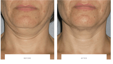 ultherapy wrinkly neck before after