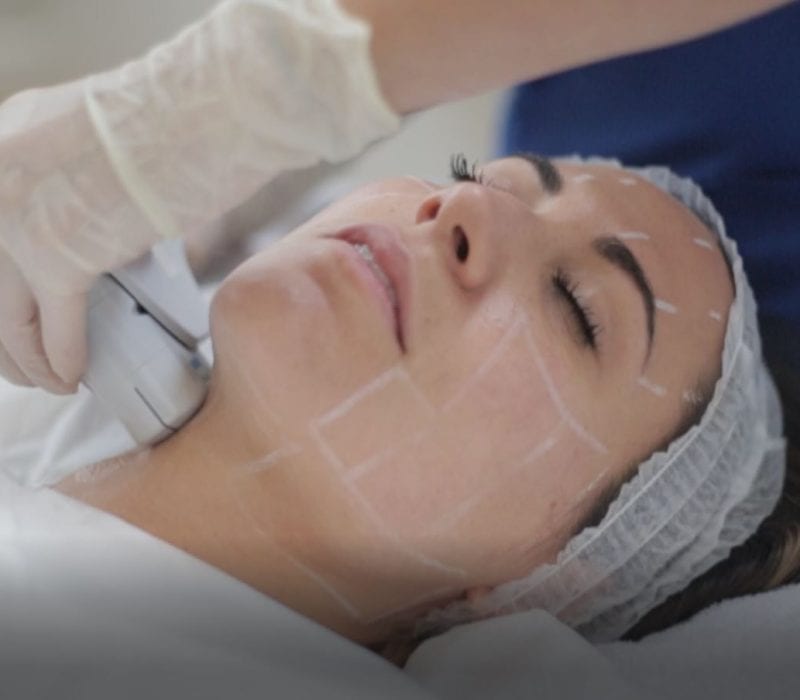 ultherapy, ultherapy treatment, ultherapy procedure