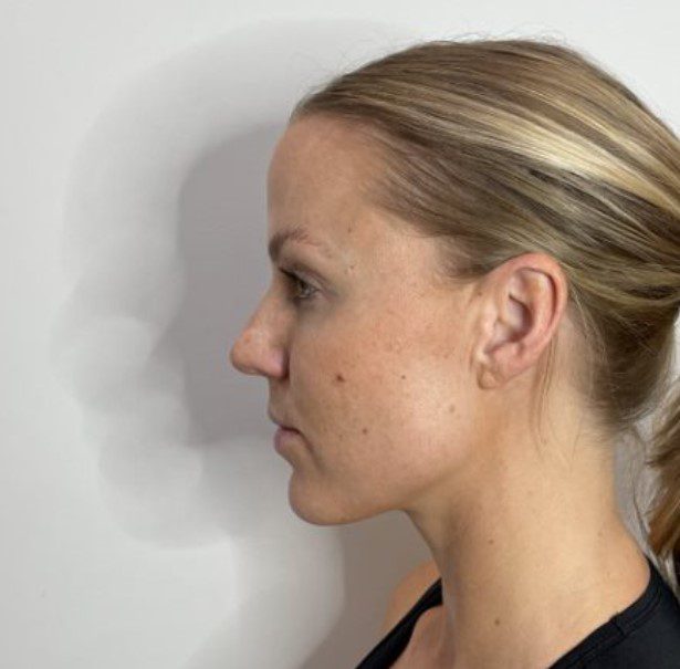 Ultherapy redefine jawline treatment after