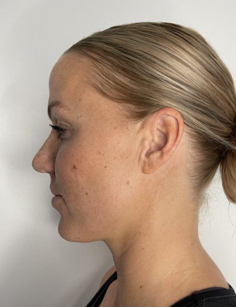 Ultherapy redefine jawline treatment before