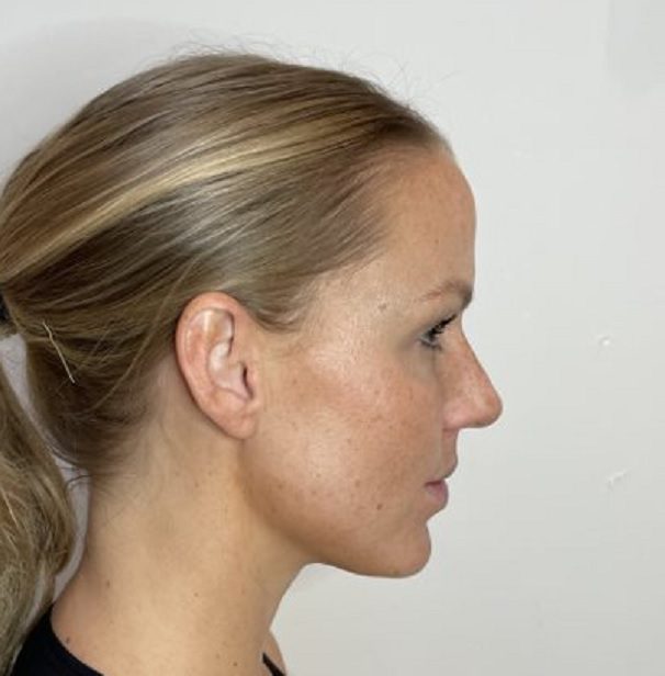 Ultherapy redefine jawline treatment after