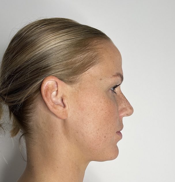 Ultherapy treatment before for jawline