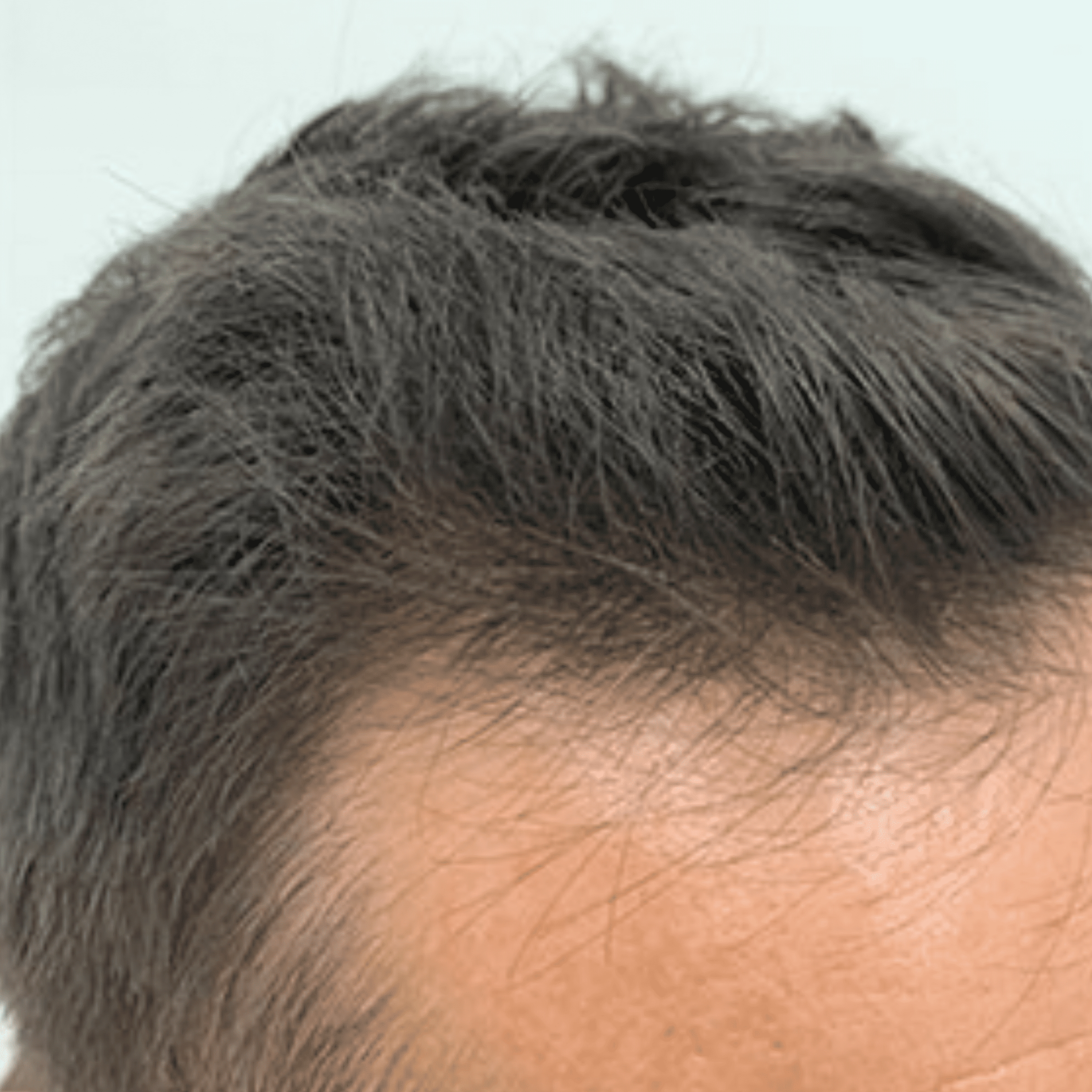 Non-Surgical Hair Loss Treatment