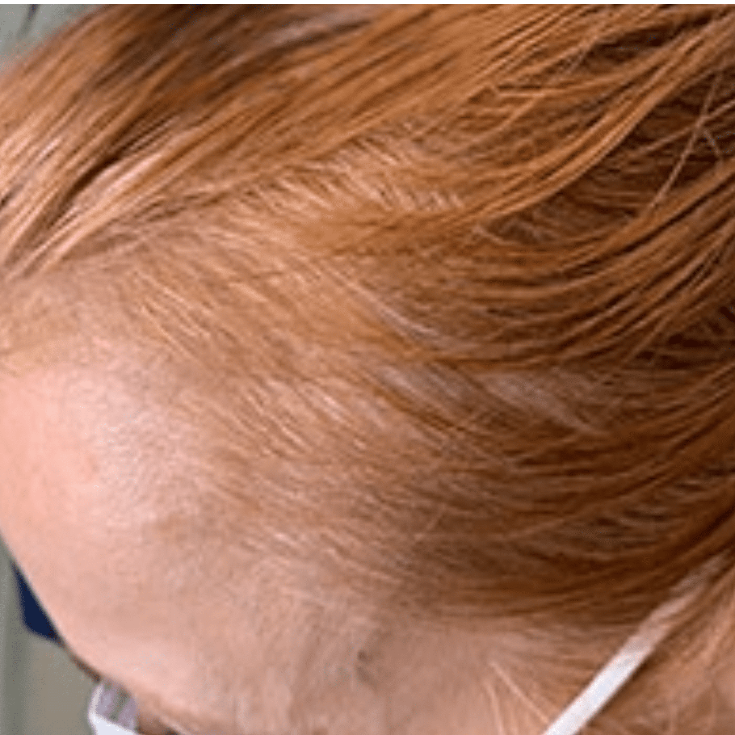 Non-Surgical Hair Loss Treatment