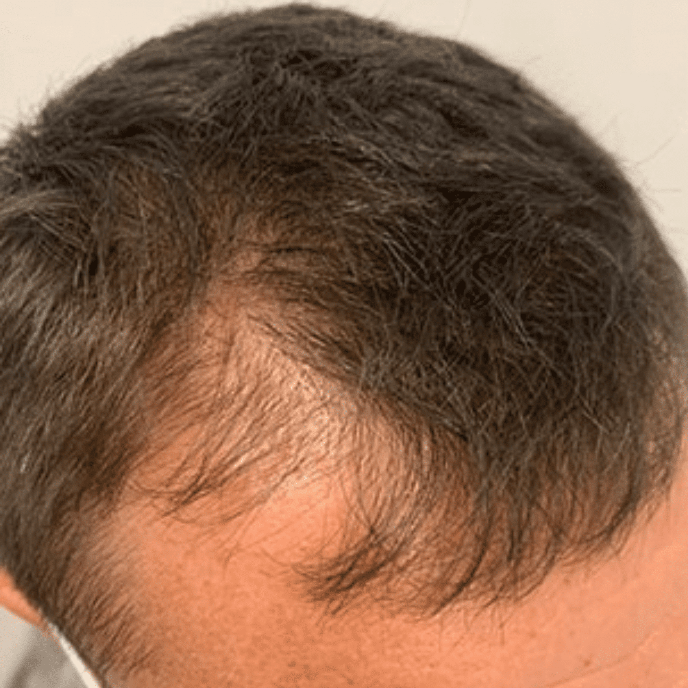 Non-Surgical Hair Loss Treatment