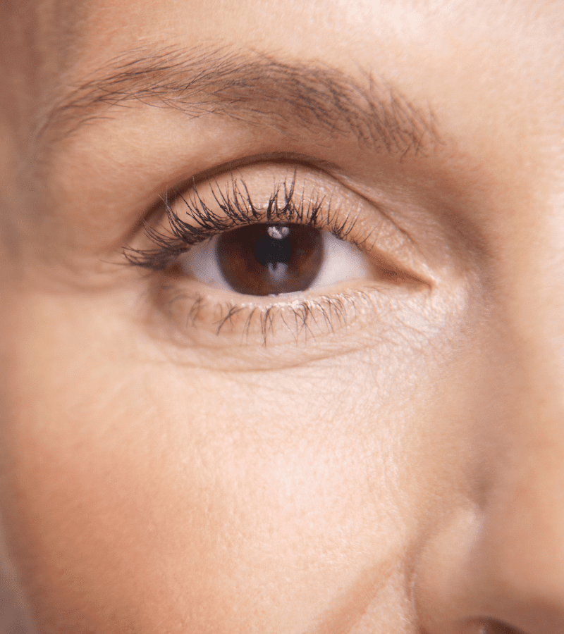 Polynucleotide Injections Under Eyes