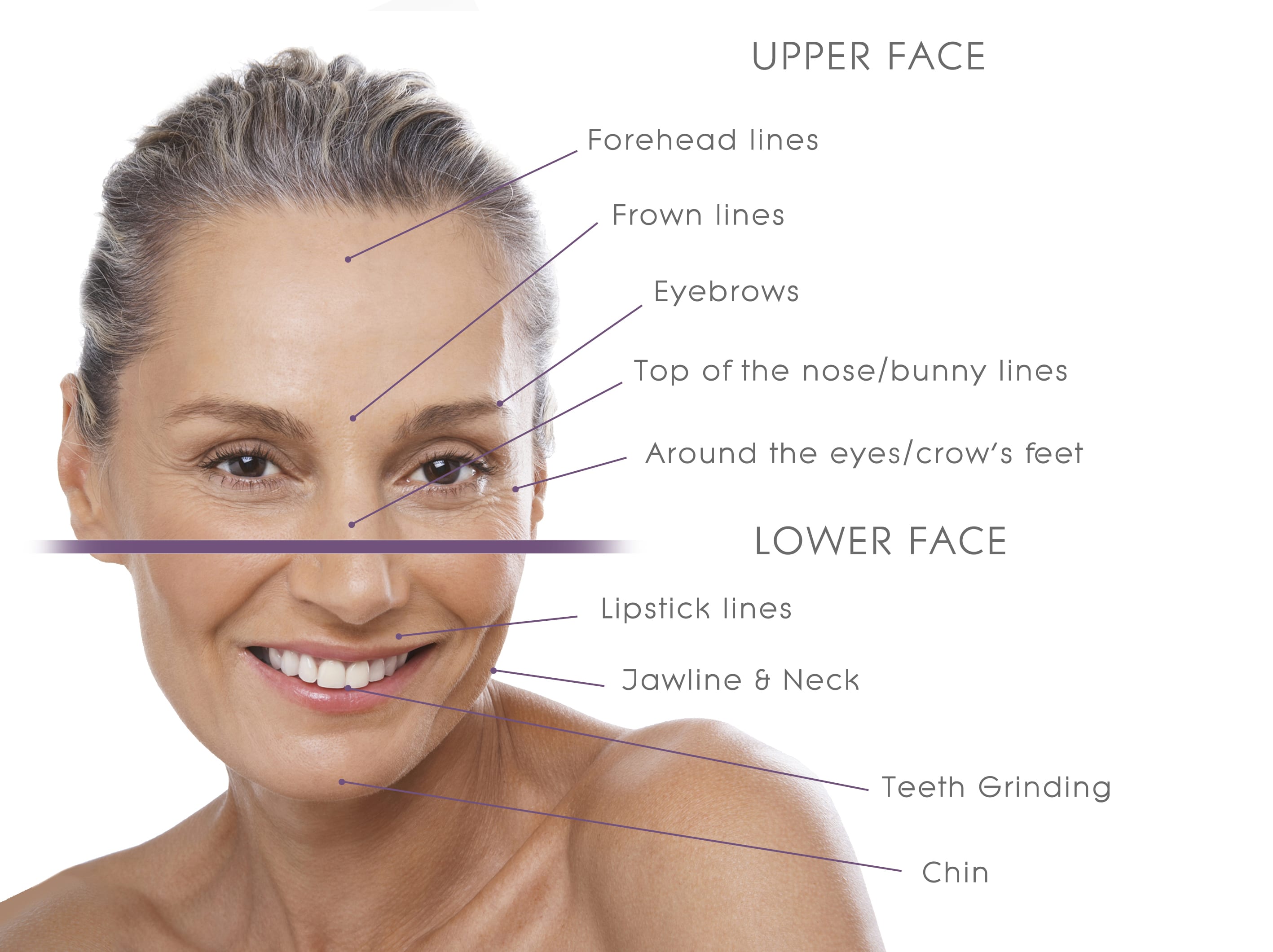 areas of the face to treat with botox