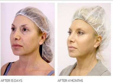 Woman before and after