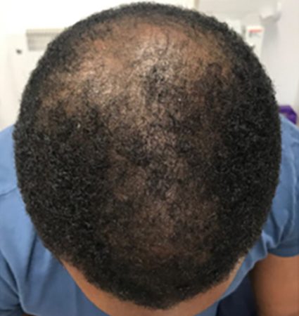 Calecim Advanced Hair System